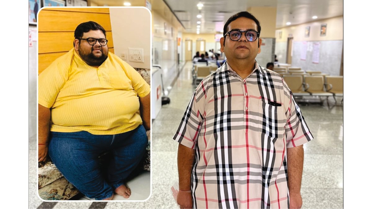 NOBESITY Surgery Helps Ahmedabad Resident Lose 109 Kg, Transforming Health and Life